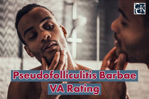 Pseudofolliculitis barbae va rating  In one study in the United States military, where a clean-shaven appearance is a component of military grooming standards, pseudofolliculitis barbae was detected in 45 percent of 50 Black males hospitalized for other indications, a rate considered to be much higher than the prevalence in White military service members [ 2-4 ]